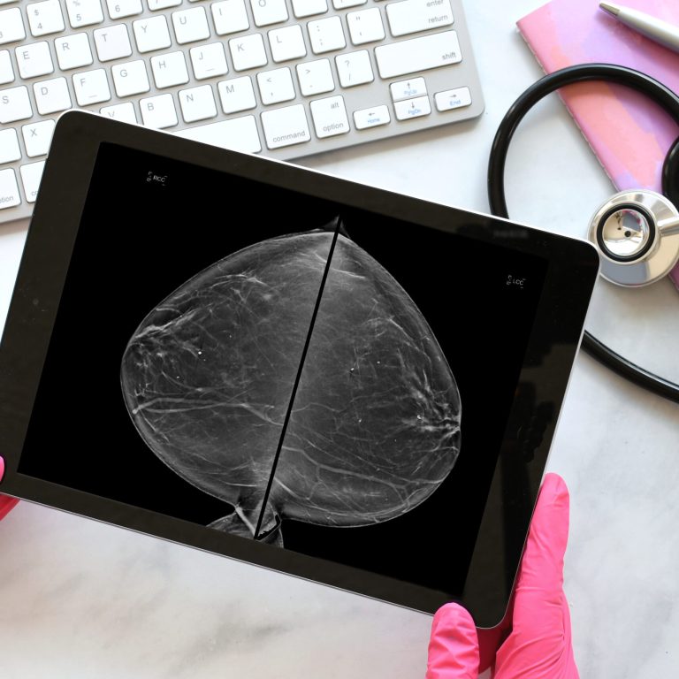 Mammogram images showing dense breast tissue on a tablet